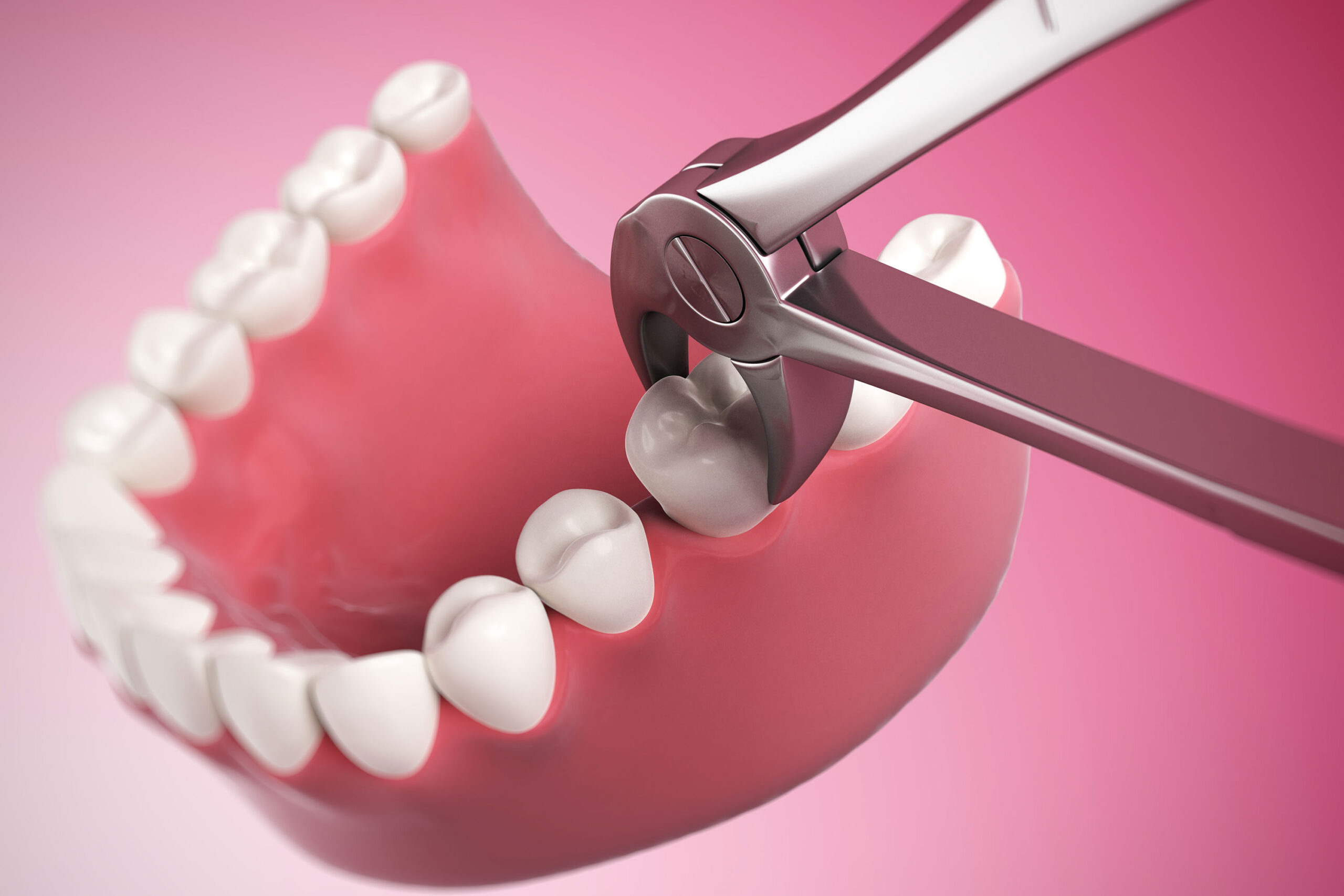 Donald Phillips Oral Surgery Single Tooth Extraction Image