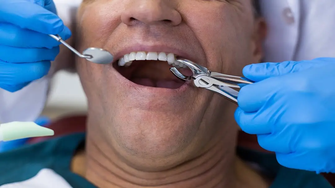 Donald Phillips Oral Surgery Single Tooth Extraction Image